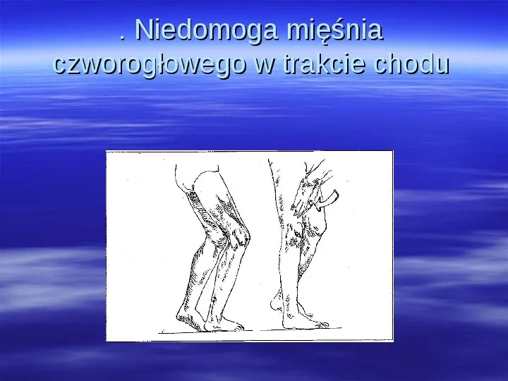 Patologia chodu - Slide 40