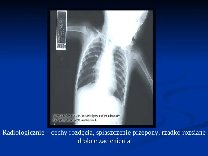 Ostre choroby układu oddechowego - Slide 23