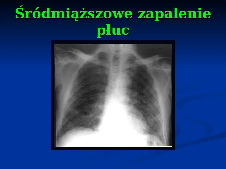 Ostre choroby układu oddechowego - Slide 35