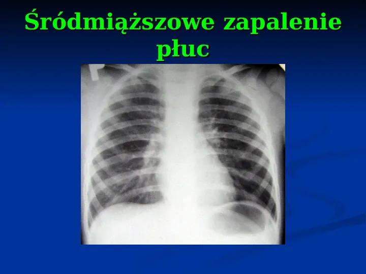 Ostre choroby układu oddechowego - Slide 36