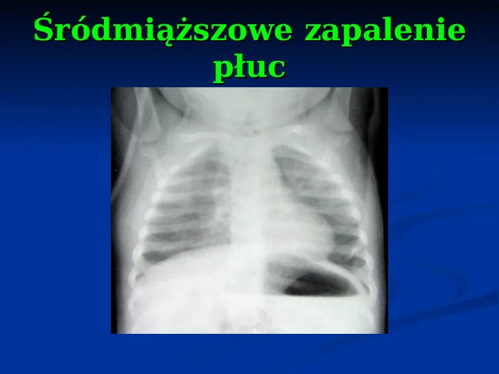 Ostre choroby układu oddechowego - Slide 37