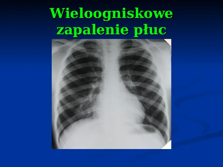 Ostre choroby układu oddechowego - Slide 40