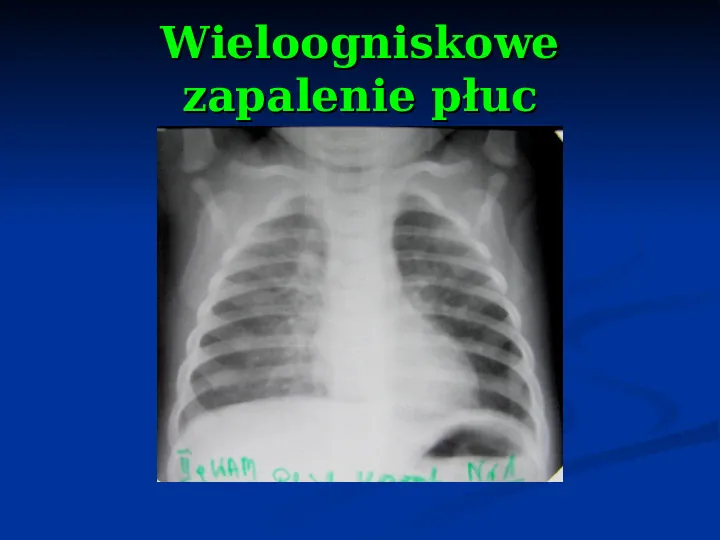 Ostre choroby układu oddechowego - Slide 41