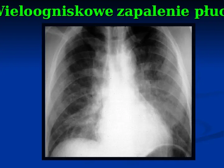 Ostre choroby układu oddechowego - Slide 43
