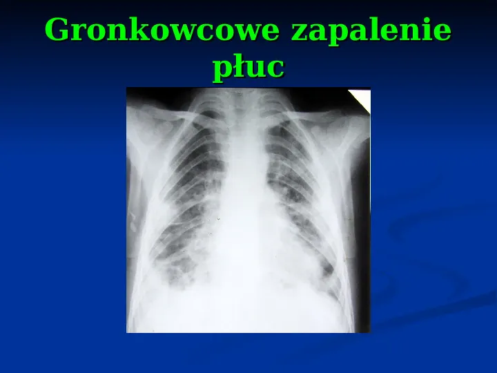 Ostre choroby układu oddechowego - Slide 45