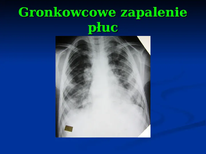 Ostre choroby układu oddechowego - Slide 46