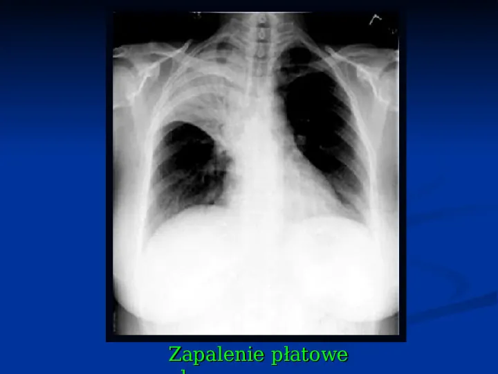 Ostre choroby układu oddechowego - Slide 48