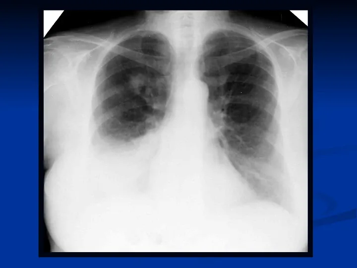 Ostre choroby układu oddechowego - Slide 51