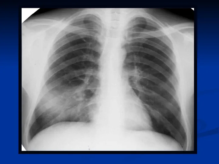 Ostre choroby układu oddechowego - Slide 52