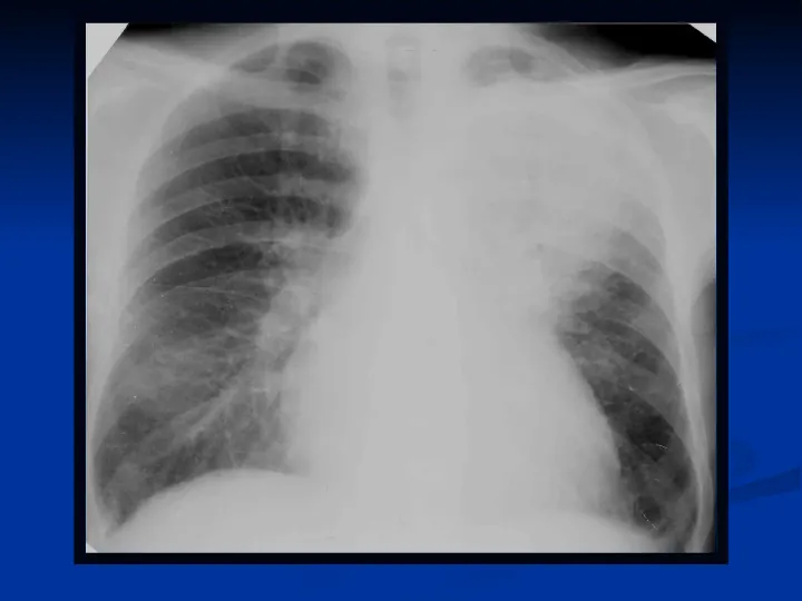 Ostre choroby układu oddechowego - Slide 53