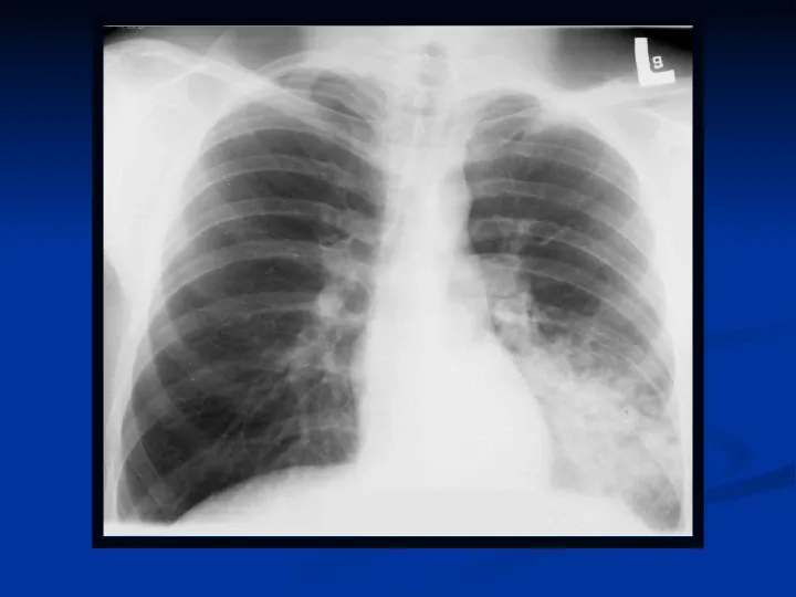 Ostre choroby układu oddechowego - Slide 54