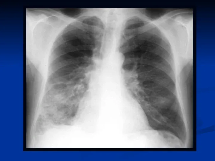 Ostre choroby układu oddechowego - Slide 55