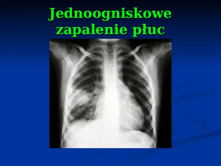 Ostre choroby układu oddechowego - Slide 57