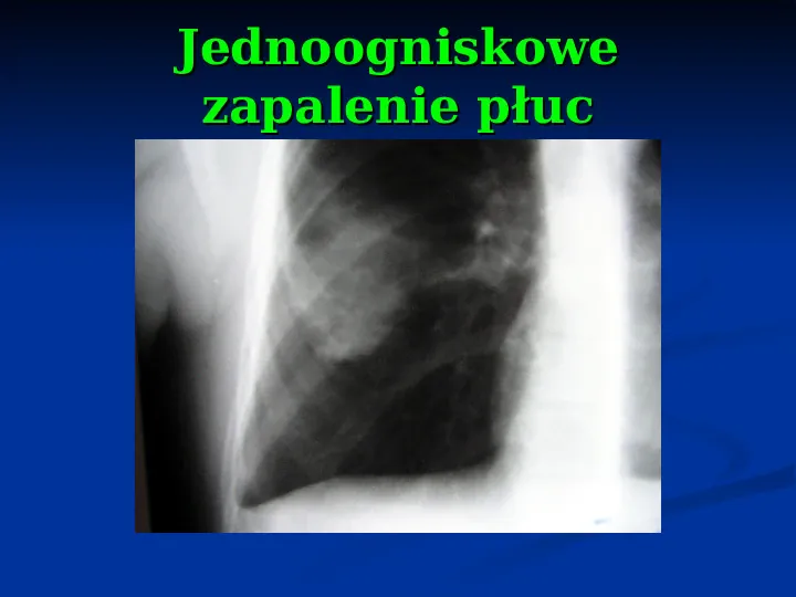 Ostre choroby układu oddechowego - Slide 58