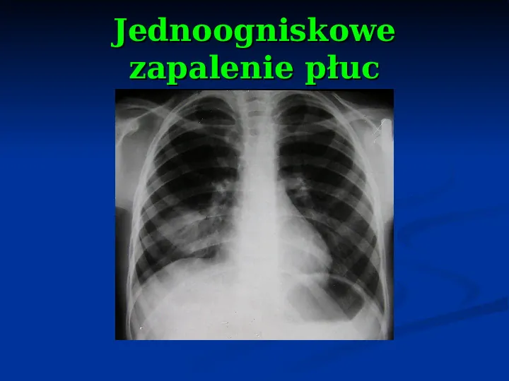 Ostre choroby układu oddechowego - Slide 61
