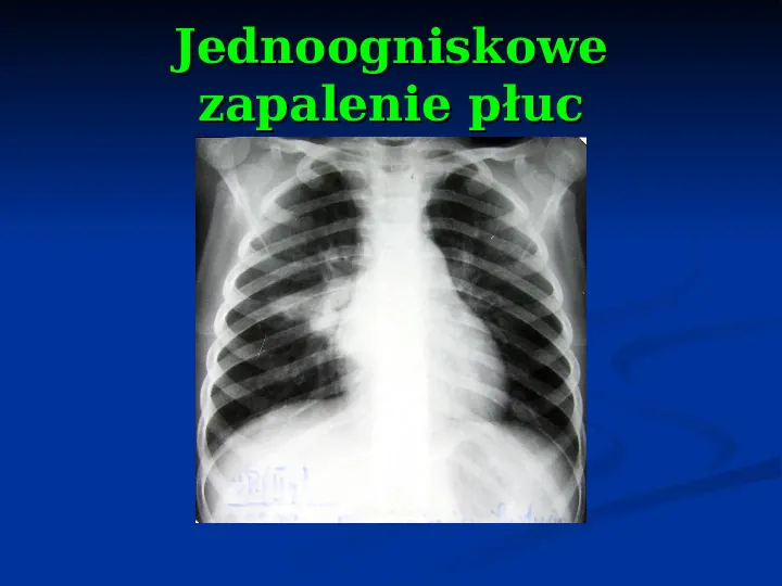Ostre choroby układu oddechowego - Slide 62