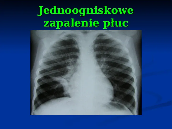 Ostre choroby układu oddechowego - Slide 63
