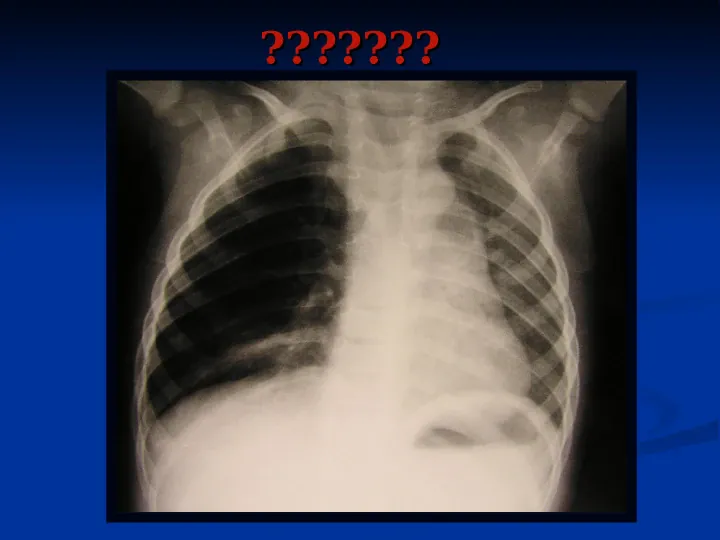Ostre choroby układu oddechowego - Slide 65