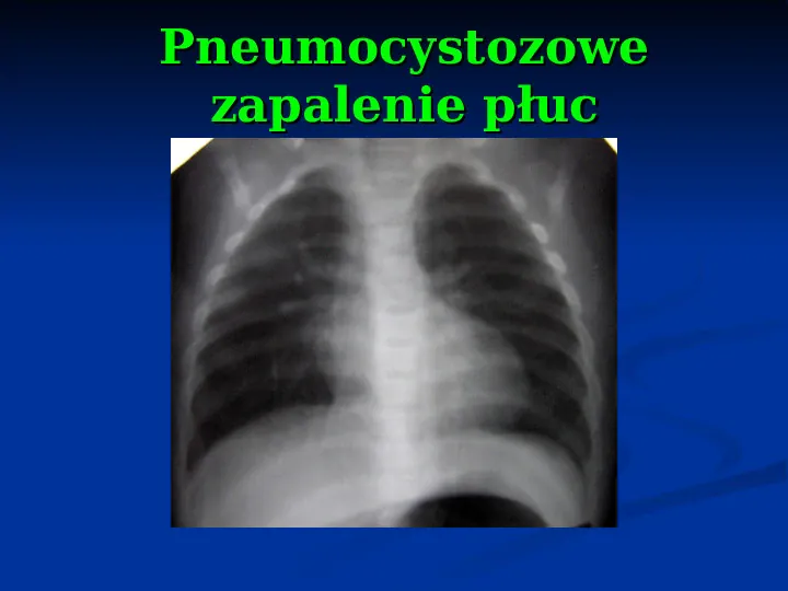 Ostre choroby układu oddechowego - Slide 77