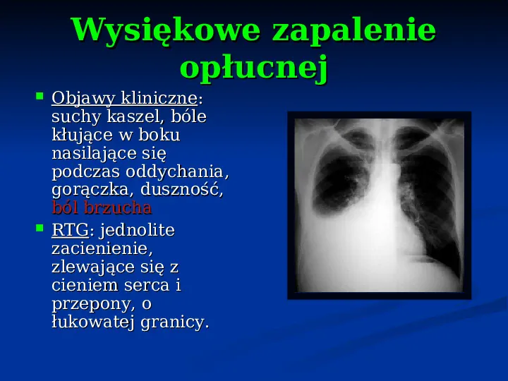 Ostre choroby układu oddechowego - Slide 80