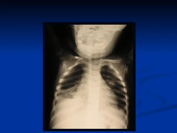 Ostre choroby układu oddechowego - Slide 81