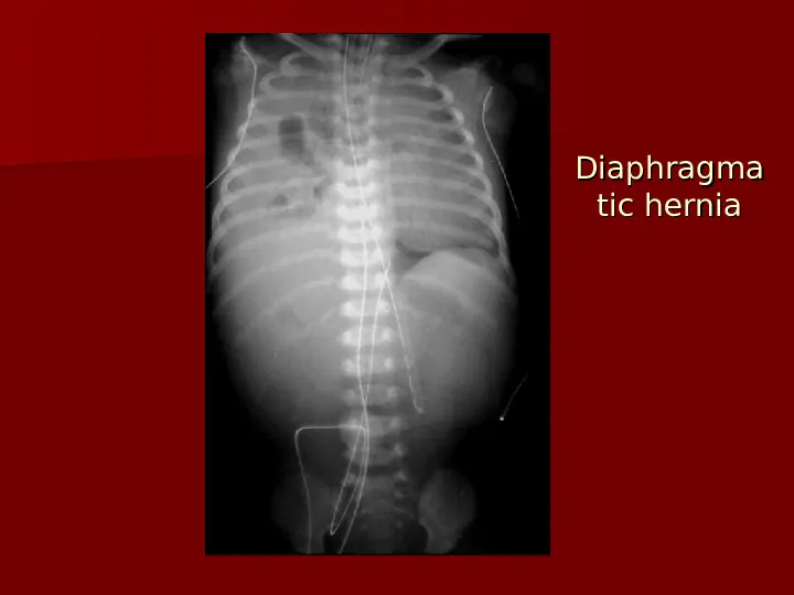 Choroby układu oddechowego - Slide 18