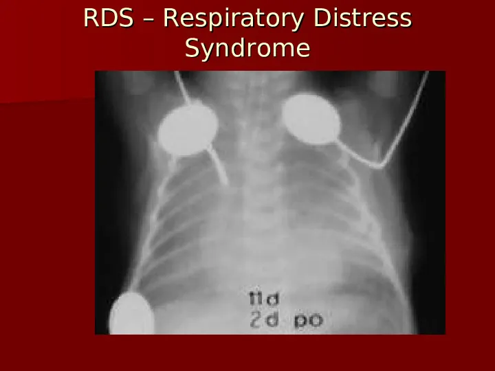 Choroby układu oddechowego - Slide 42