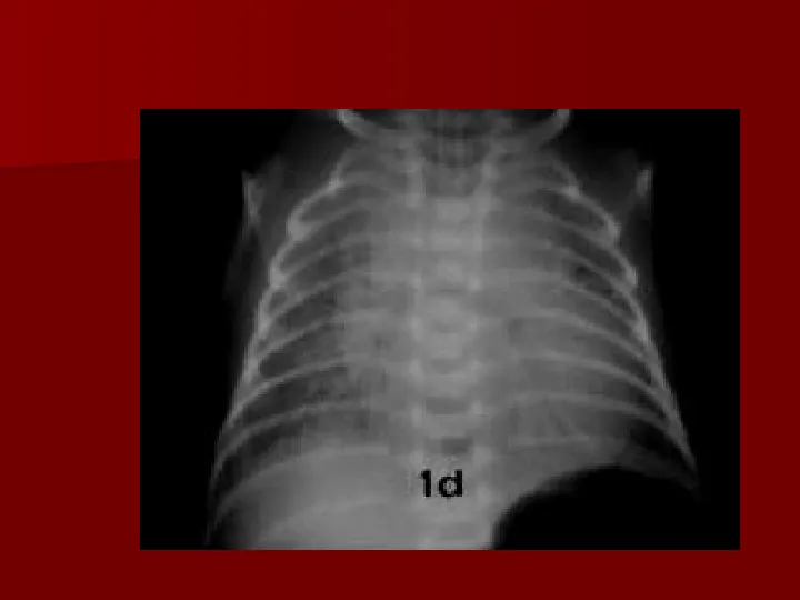Choroby układu oddechowego - Slide 43