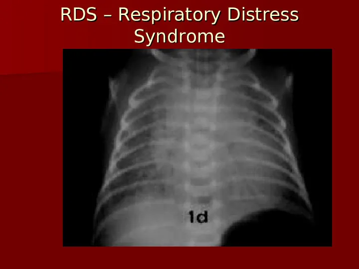Choroby układu oddechowego - Slide 44