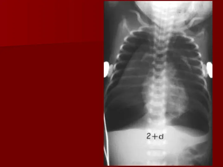 Choroby układu oddechowego - Slide 46