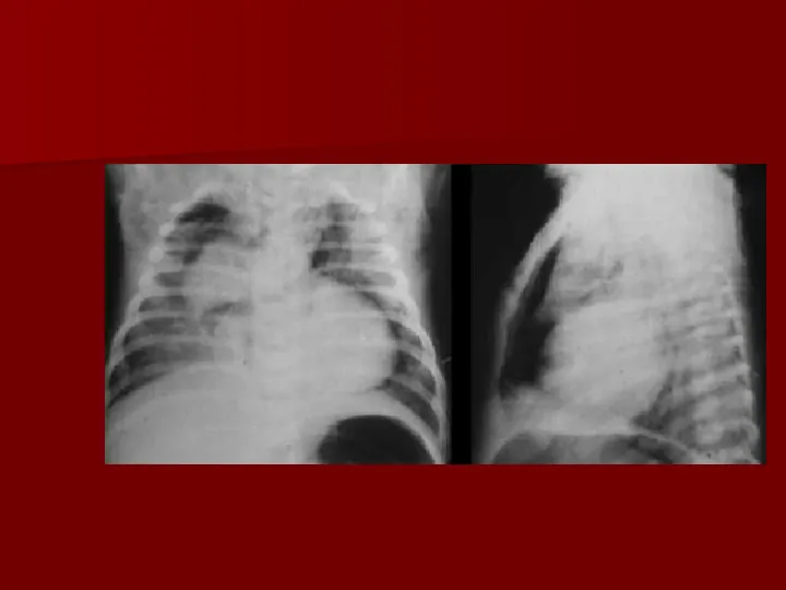 Choroby układu oddechowego - Slide 48