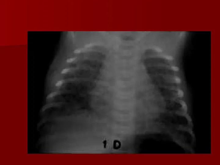 Choroby układu oddechowego - Slide 50