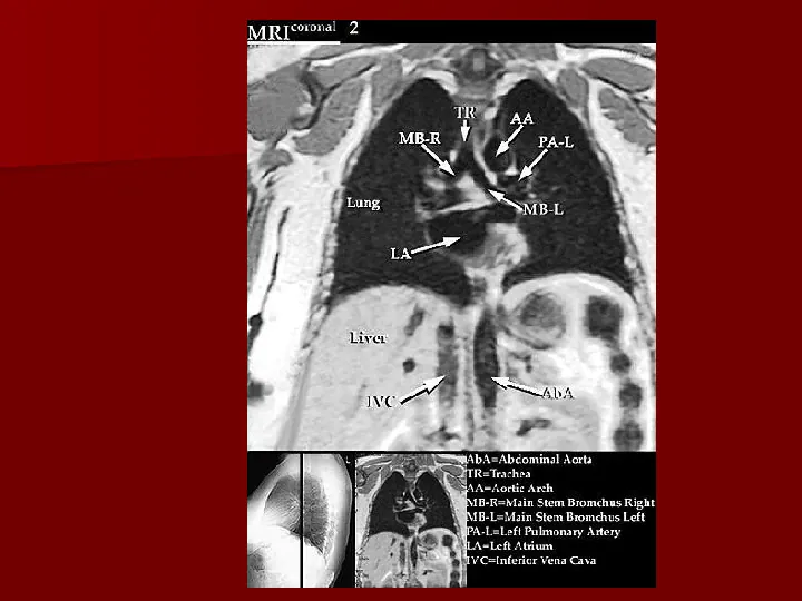 Choroby układu oddechowego - Slide 58